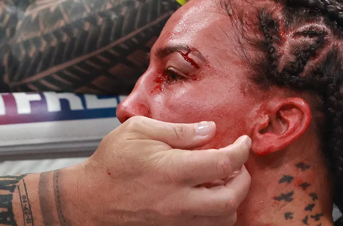 The cut over Jessa Camara's left eye.